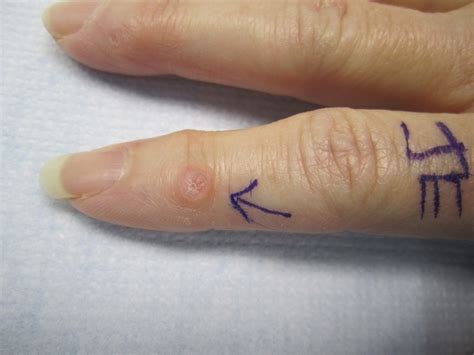 Hard Lump On Finger Joint Under Skin