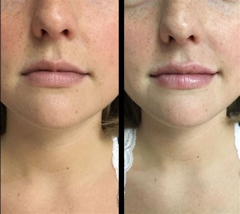 Half A Syringe Lip Filler Before And After Before And After