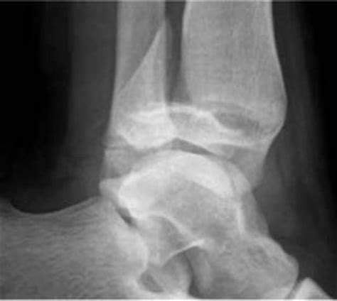 Ankle Fractures - Pediatric - Pediatrics - Orthobullets