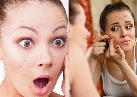Top 10 Medicines To Treat Pimples Techatlasts