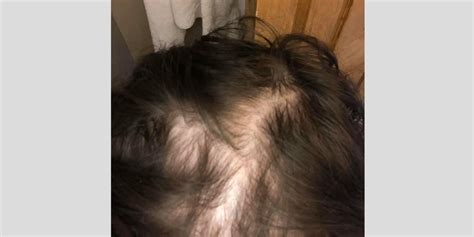 Scalp Problems That Cause Hair Loss Psoriasis And Hair Loss Scalp