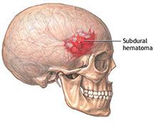 In pazienti con emorragia subaracnoidea, un'angiografia cerebrale convenzionale deve essere effettuata appena possibile dopo l'episodio di sanguinamento iniziale; Emorragia cerebrale: definizione - Infiammazione.com
