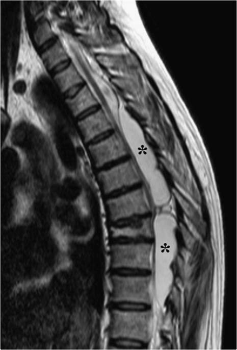 Spinal Extradural Arachnoid Cyst T2 Weighted Image Of Magnetic