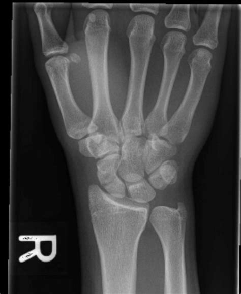 Hand And Wrist Fractures Undergraduate Diagnostic Imaging Fundamentals