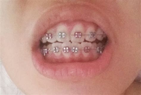 pin on cute colors for braces