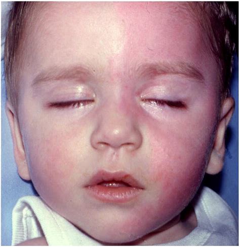 Asymmetric Sweating And Flushing In Infants With Esophageal Atresia