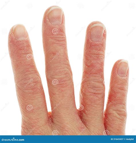 Closeup Of Eczema Dermatitis On Fingers Stock Image Image 31643437