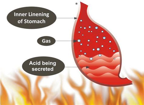 Burning Stomach Pain In The Morning Causes And When To See A Doctor