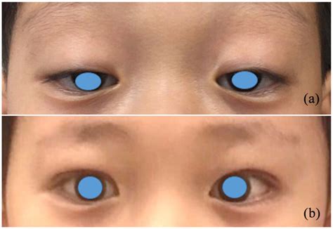 Surgical Correction Of Severe Congenital Ptosis Using A Modified