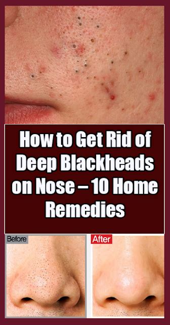 10 Ways To Get Rid Of Deep Blackheads Healthy Lifestyle