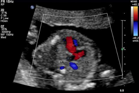 Cardiovascular System Hypoplastic Left Heart Embryology