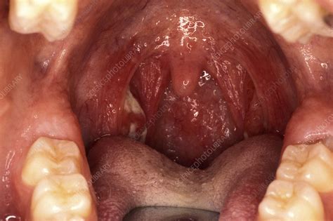 Ulcerated Tonsils Throat Examination Stock Image M2700340 Science Photo Library
