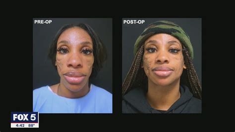 After Lupus Changed Her Face Atlanta Woman Turns To Surgery For Second