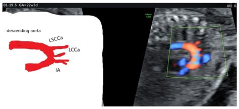 Diagnostics Free Full Text Prenatal Diagnosis Of Bovine Aortic Arch