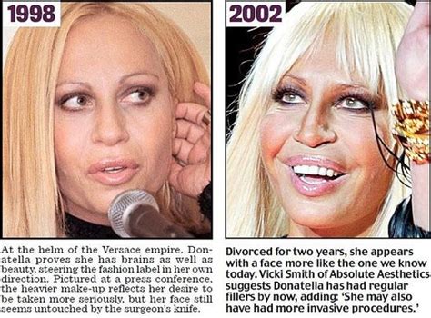 Pin By Susanafrankel On Cosmetic Surgery No Makeup Donatella Versace Laser Resurfacing