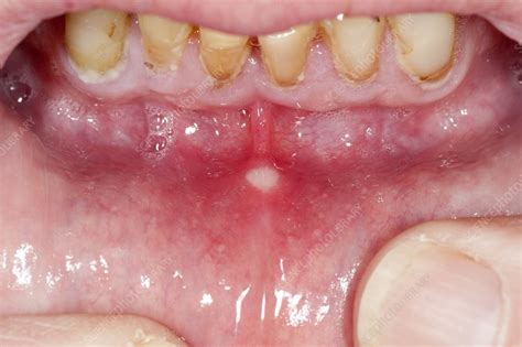 Aphthous Ulcer In The Mouth Stock Image C0130869 Science Photo