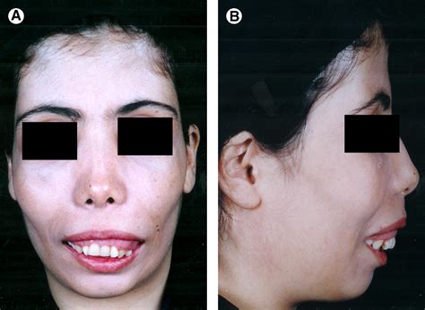 Superior Repositioning Of The Maxilla In Thalassemia Induced Facial