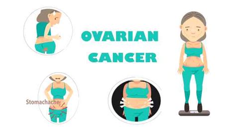 Age when menstruation started and ended.beginning menstruation at an early age or starting menopause at a later age, or both, may increase the risk of ovarian cancer. Myth busted! Most ovarian cancers start in fallopian tubes ...