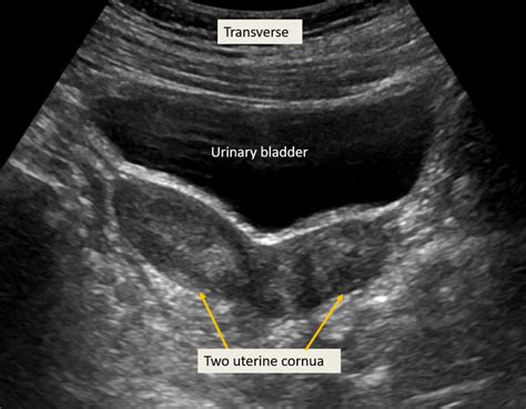 Coronal View Of The Fundus Of The Uterus On Transvaginal Ultrasound