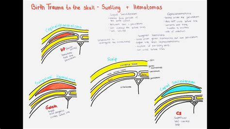 Caput Succedaneum Cephalohematoma Subgaleal Hemorrhage Youtube