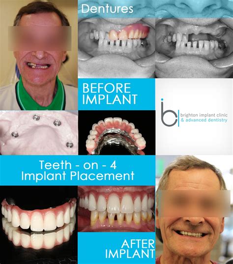Another Brighton Implant Clinic Successful Case Dentalimplant