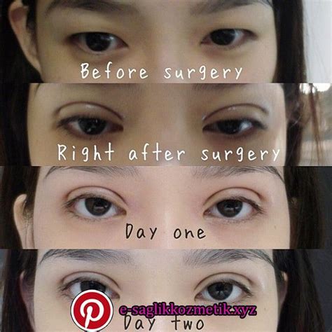 In surgery, an incision is made along the whole upper eyelid, fat pads are removed partially, and certain layers of the skin is anchored to deeper structures to create a lid crease. My double eyelid surgery experience My double eyelid ...