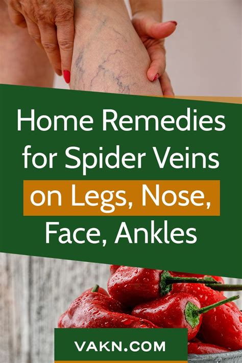 Home Remedies For Spider Veins Natural Herbal Removal Of Spider Veins In 2020 Home Remedies