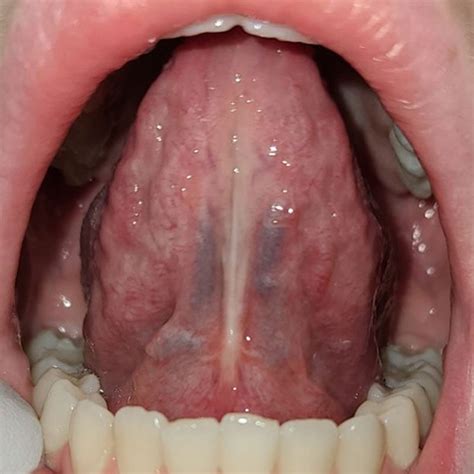 Tongue Tie Fascia Release With Lightscalpel Laser Update