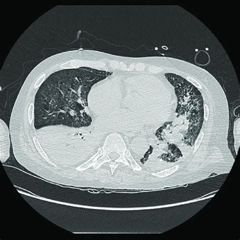 Ct Chest Showing Diffuse Bilateral Interstitial Opacities And