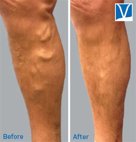 Know The Signs Symptoms And Treatments For Varicose Veins Portland