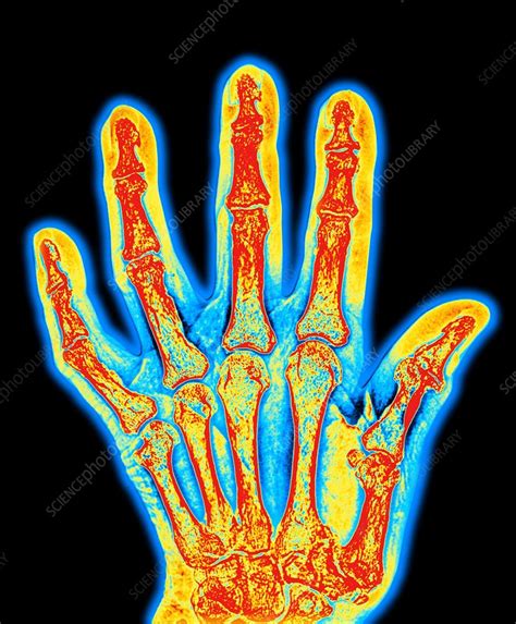 Arthritic Hand Bones Stock Image M1100527 Science Photo Library