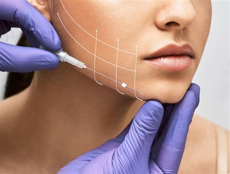 Thread Lift For Facial Rejuvenation Skin Institute Nz