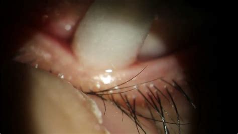 Squeezing A Chalazion Through The Meibomian Gland Youtube