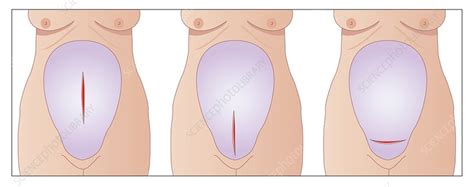 Caesarean Section Womb Incisions Artwork Stock Image C008 4462 Science Photo Library
