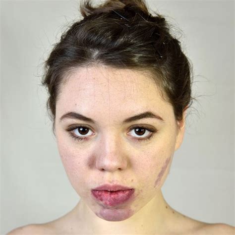 Model Bullied For Facial Birthmark Poses Proudly After 40 Laser