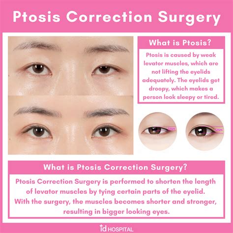 Ptosis Correction Surgery At Id Hospital Asian Eyes Plastic Surgery