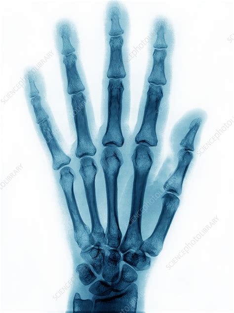 This chapter reacquaints you with the normal anatomy by being systematic, you will miss fewer important findings—not that experienced hands don't miss findings; Normal Hand, X-ray - Stock Image - C027/2182 - Science ...