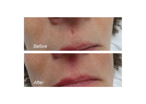 Vascular Laser Treatment Melbourne Collins Cosmetic Clinic