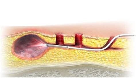 Silac® Laser Therapy Non Surgical Pilonidal Cyst Treatment