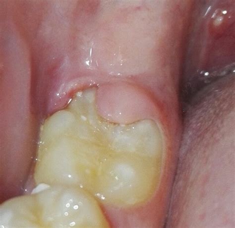 Lump Of Gum Growing Over Tooth Dentistry