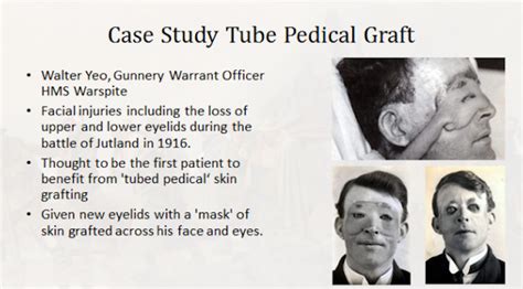 World War I The Birth Of Plastic Surgery And Modern Anaesthesia