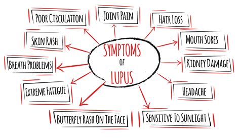 Signs And Symptoms Of Lupus St Michaels Elite Hospital