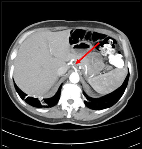 Computed Tomography Á Chest Abdomen And Pelvis From The Second