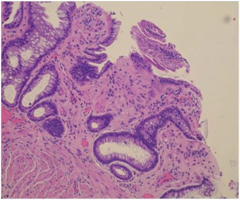 My Gastro Room Solitary Rectal Ulcer Syndrome