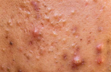 Close Up Photo Of Nodular Cystic Acne Blemish Spots Skin On Man Face Acne Support