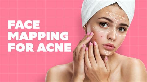 Face Mapping For Acne Skincare Tips Treatment For Acne Ft Dr