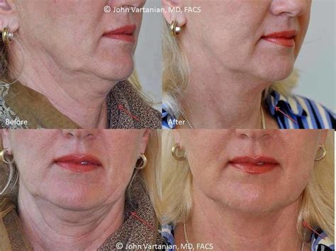 Thermage For Neck Before And After 6 Facelift Info Prices Photos