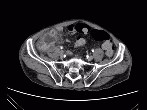 ct scan of abdomen demonstrating peri appendiceal abscess with download scientific diagram