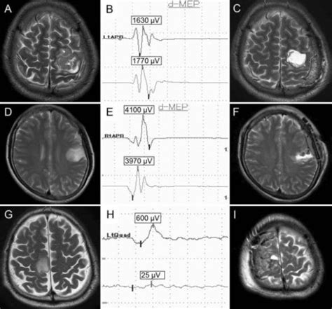 Awake Vs Asleep Motor Mapping For Glioma Resection A Systematic