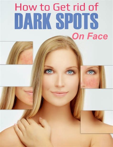 How do you get rid of dark marks on your legs? How To Get Rid Of Dark Spots On Face | Rosacea, Dark spots ...